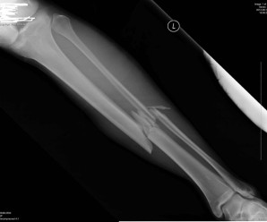broken arm xray